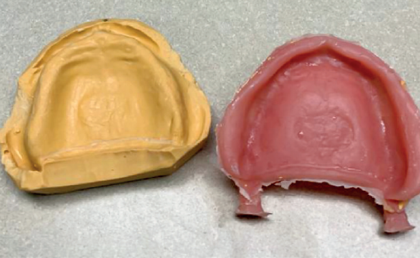 9) Rimuovere la protesi, rifinire e lucidare Image